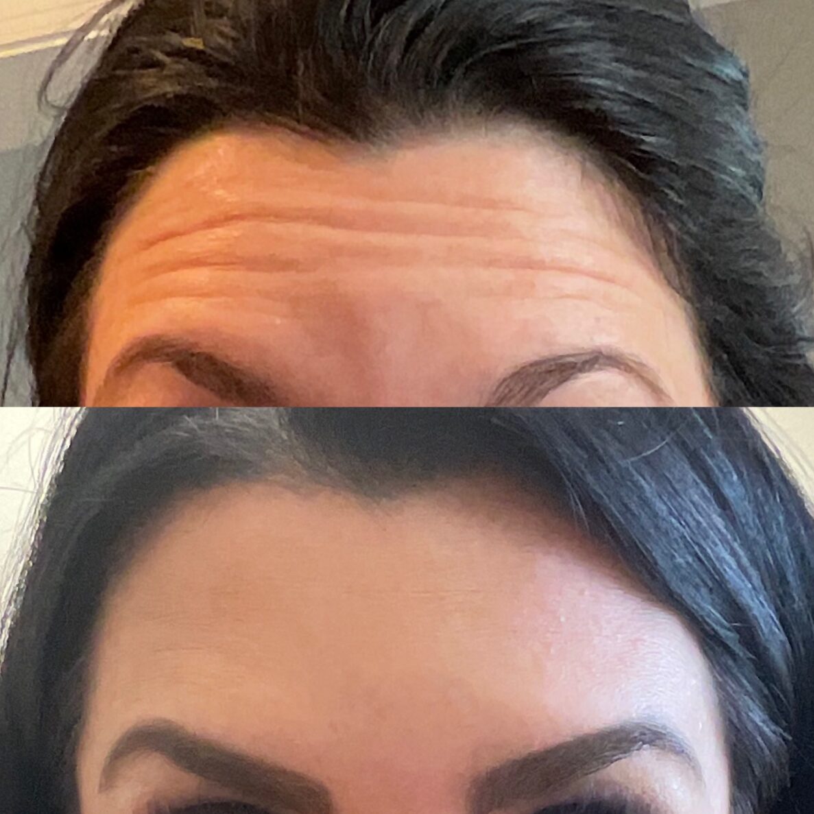 Botox in Lebanon, TN | Restoration Wellness and Medspa